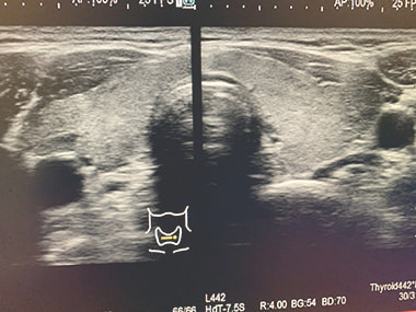 甲状腺